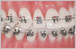 Self Ligating Braket